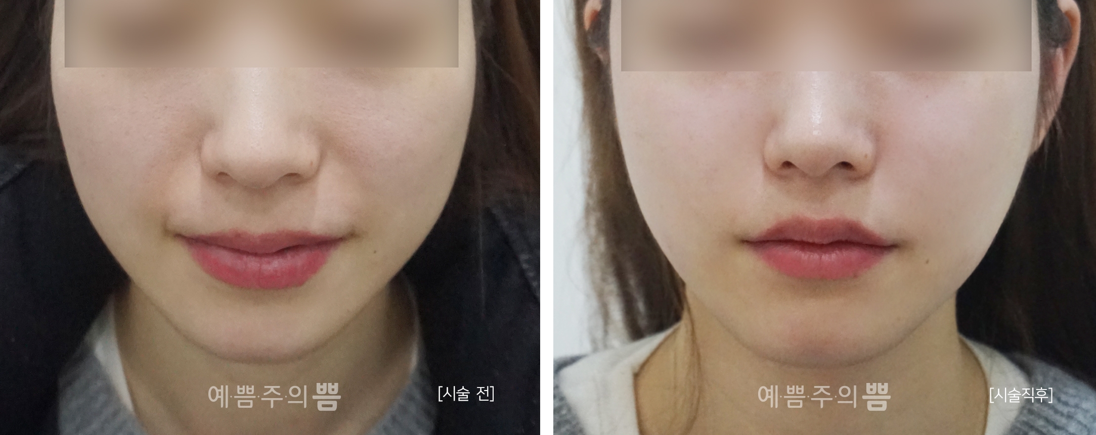 신논현점_큐오필 앞볼+팔자