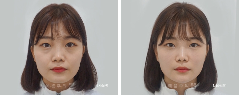 신논현점_큐오필(앞볼, 팔자주름, 턱끝)