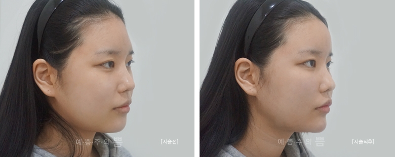 신논현점_큐오필(팔자주름, 턱끝, 이마)