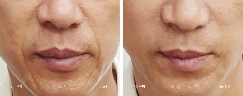 신논현점_민트실+팔자필러+주름보톡스